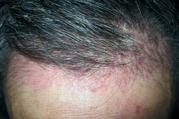 Biểu hiện bệnh vảy nến da đầu
