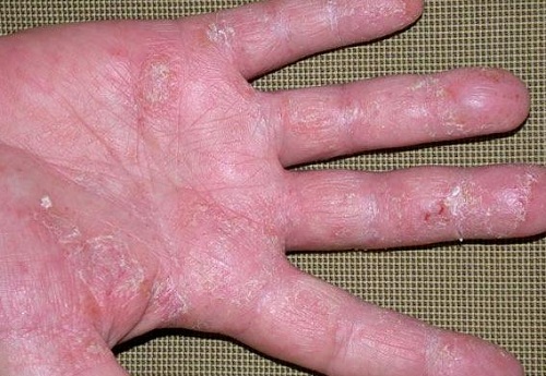 Bệnh nấm da tay là gì