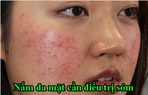 Cách diều trị nấm da mặt
