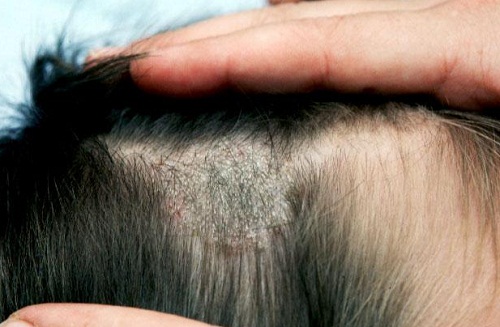 Điều trị nấm da đầu hiệu quả