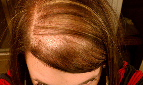 Nguyên nhân rụng tóc từng mảng