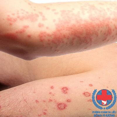 Bệnh chàm eczema là gì triệu chứng và biện pháp điều trị
