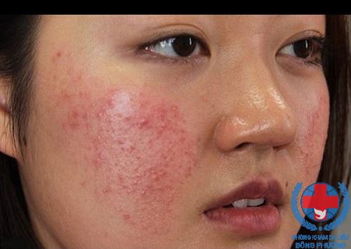 Viêm da mặt và cách trị viêm da mặt hiệu quả nhất