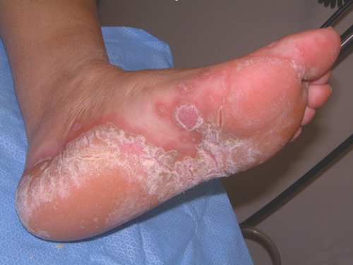 Bệnh chàm ở chân và cách trị bệnh chàm ở chân hiệu quả