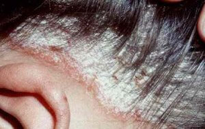 bệnh vẩy nến da đầu