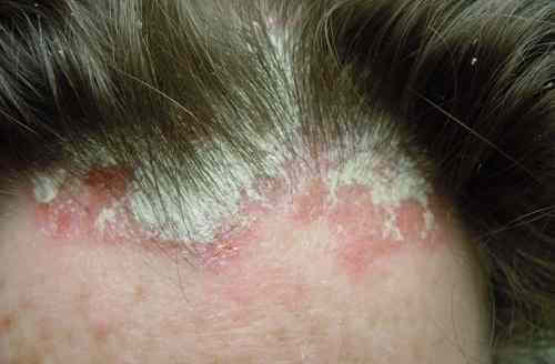 Bệnh vẩy nến da đầu và cách chữa da đầu bị vảy nến
