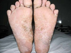 bệnh viêm da cơ địa ở chân
