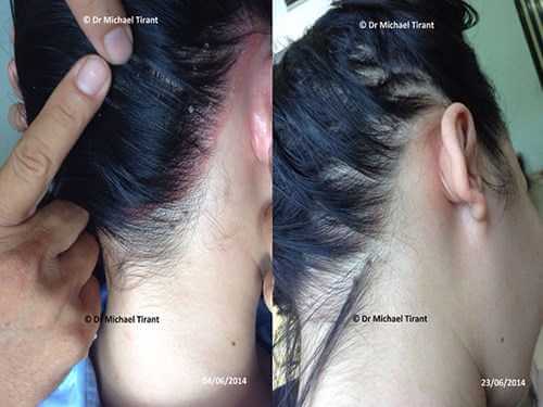 Cách chữa nấm da đầu hiệu quả nhất hiện nay