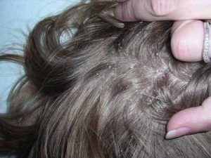 bệnh nấm tóc