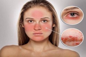nấm da mặt và cách điều trị hiệu quả