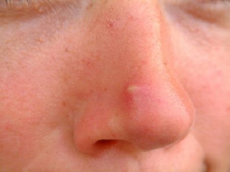 Mụn trứng cá bọc ở mũi – nguyên nhân và cách chữa
