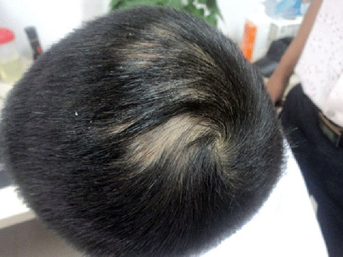 Đi tìm cách chữa trị hiệu quả bệnh rụng tóc từng mảng