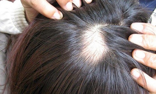 Nguyen nhân dẫn đến tụng tóc từng mảng