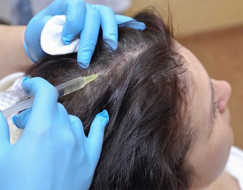 Phương pháp trị rụng tóc từng mảng