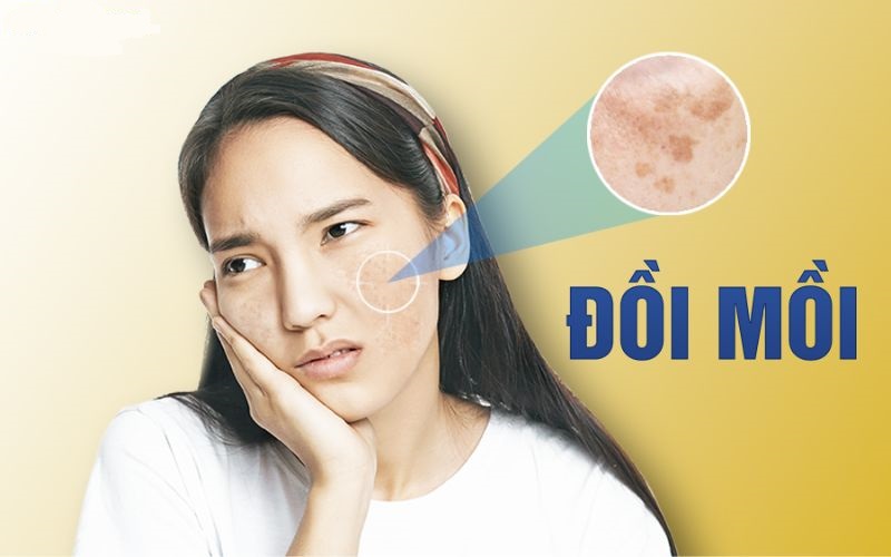 Một số lưu ý khi lựa chọn thuốc trị đồi mồi hiệu quả nhất